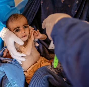 Samera* (7 months) is receiving treatment for severe acute malnutrition at a Save the Children mobile clinic in Afghanistan.